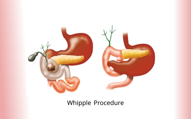 Whipple Procedure